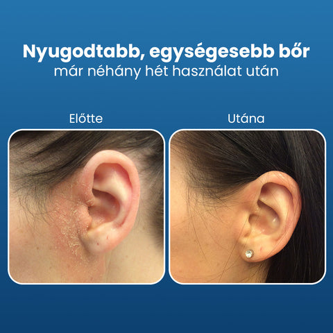 Sebovia Essence Seborrhea Dermatitis Arckrém érzékeny bőrre