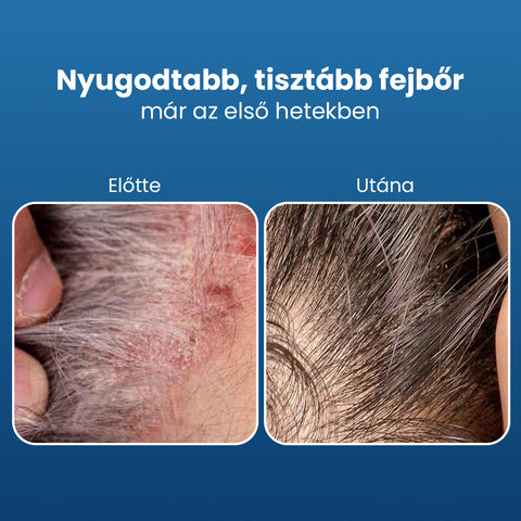 Sebovia Essence Seborrhea Dermatitis Sampon érzékeny bőrre