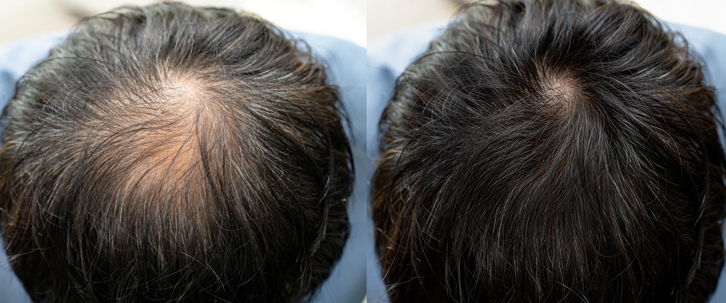 42 éves férfi, örökletes hajritkulás első jeleivel. Az 1. hónap után megszűnt a fejbőr viszketése, a 3. hónapra pedig láthatóan sűrűbb, egészségesebb hajat tapasztalt."