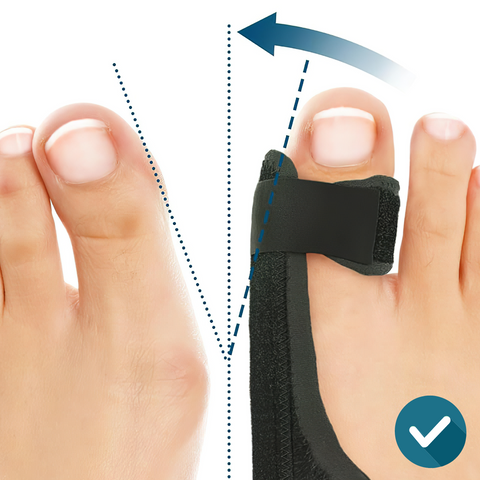 ComfyToes Nappali és Éjszakai Lábujjkiegyenesítő és Bütyök Korrektor Szett